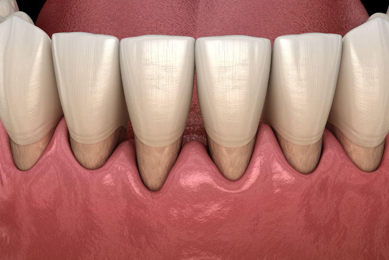 gum recession graphic