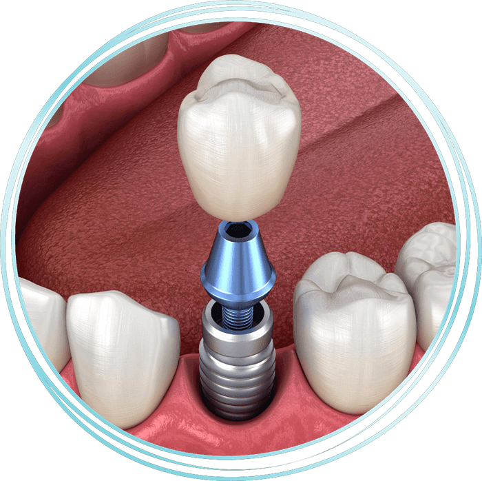 dental implant model