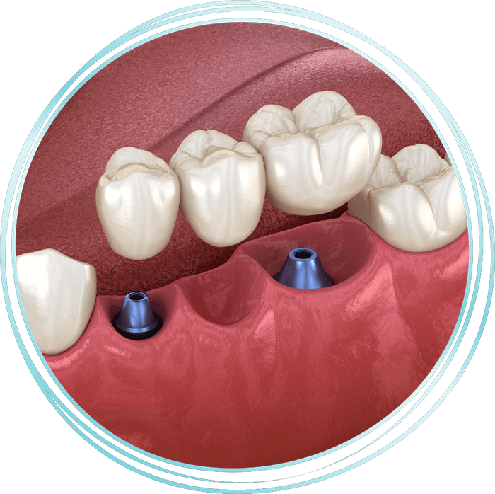 implant supported bridge model