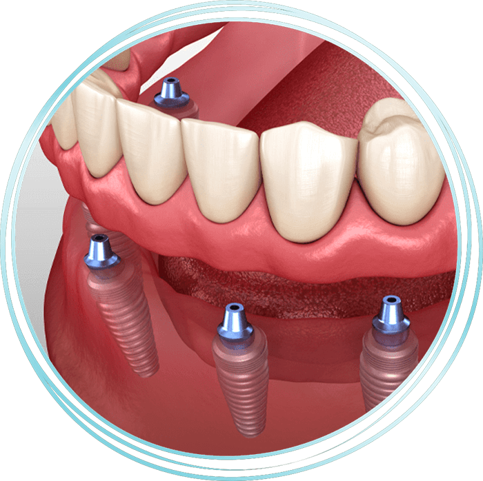 implant supported dentures model