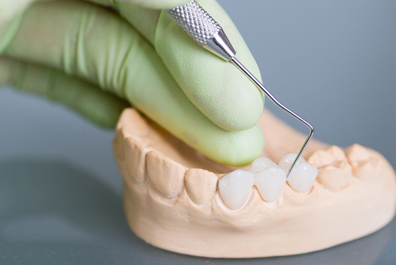 dental bridge