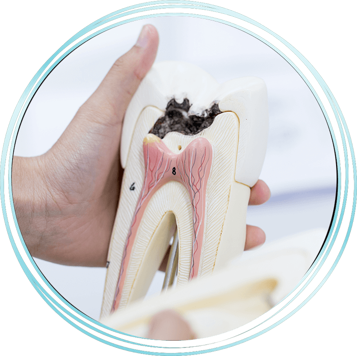 root canal model for education