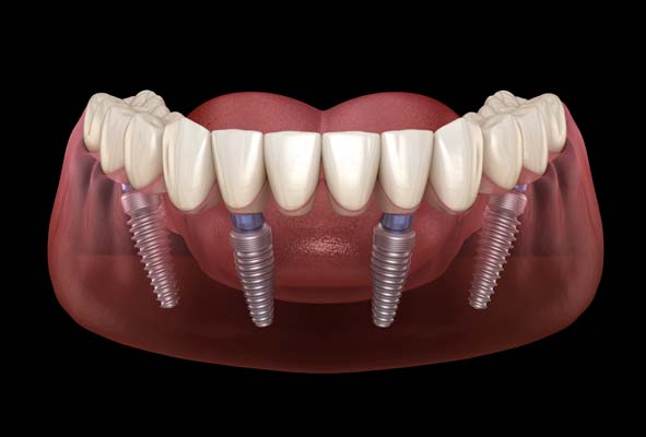 What Is All-on-4® and How Does It Replace Missing Teeth?