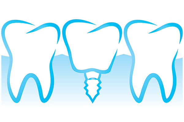 Talking to Your General Dentist About Dental Implants