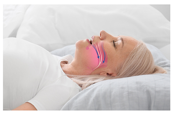 How a Dental Oral Appliance Helps with Sleep Apnea