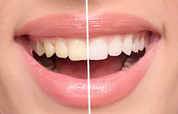 How Often Can I Get Teeth Whitening Done?