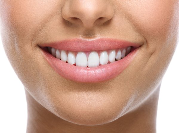 Dental implant Smiling