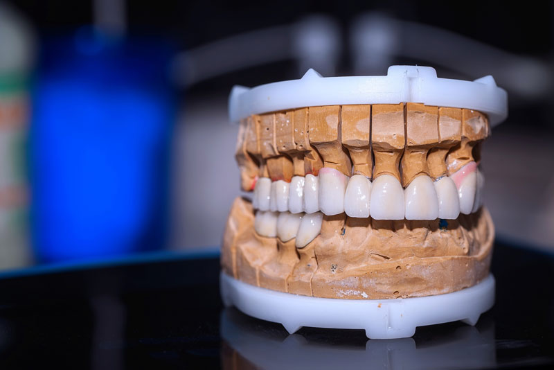 Am I Able To Have A Full Arch Of Missing Or Damaged Teeth Replaced?