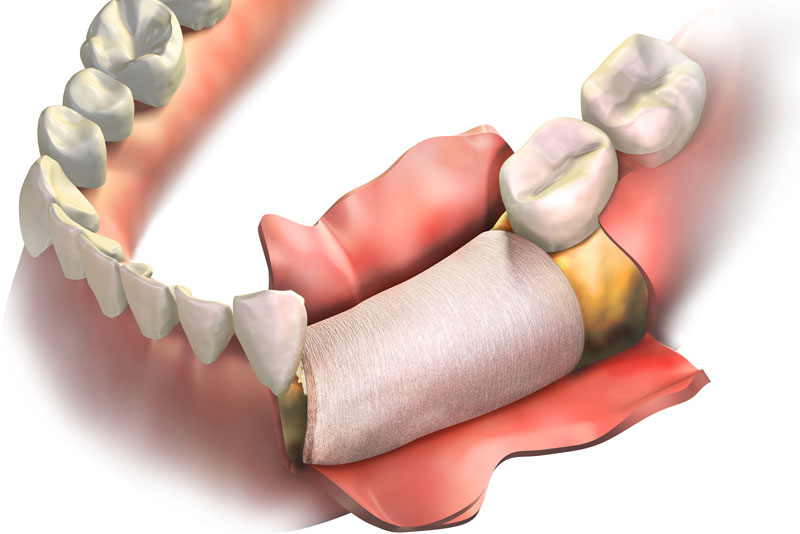 Should I Get Dental Implants After A Bone Grafting Procedure?