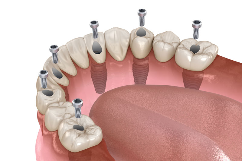 a full mouth dental implant model showing how the dental implants can be strategically placed in the patients jawbone to support a prosthesis when they have lost some jawbone density.
