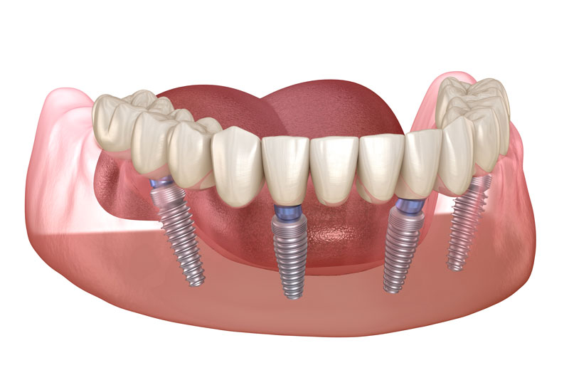 In What Ways Can All-On-4® Dental Implants Benefit Me?