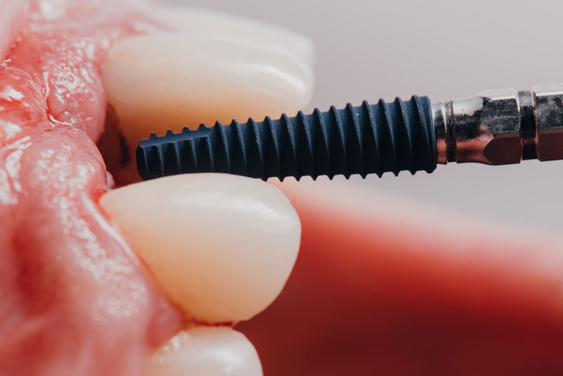 Are Dental Implants In Baton Rouge, LA Able To Restore My Smile?