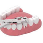 An image of a tooth extraction taking place with dental tool grabbing a tooth.
