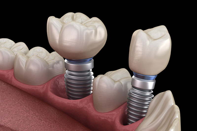 Are There Aesthetic And Functional Benefits To Getting Treated With Multiple Dental Implants?