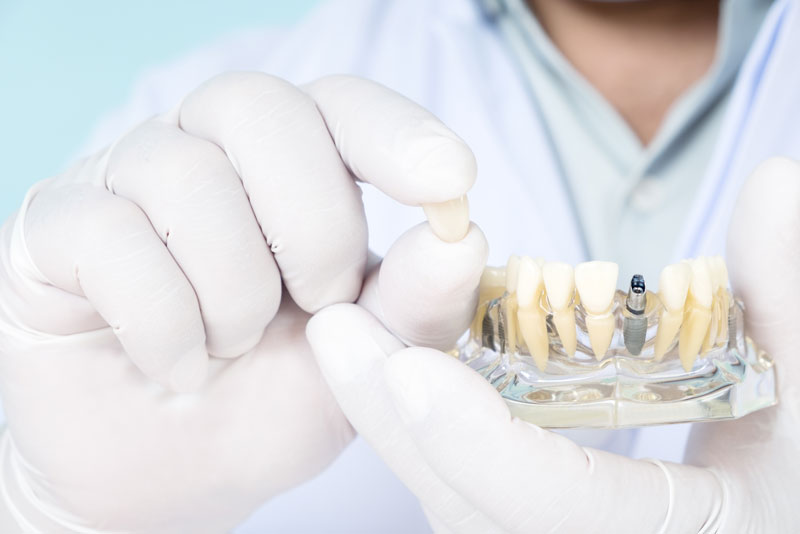Is There A Difference Between Implant Supported Dentures And Full Mouth Dental Implants?