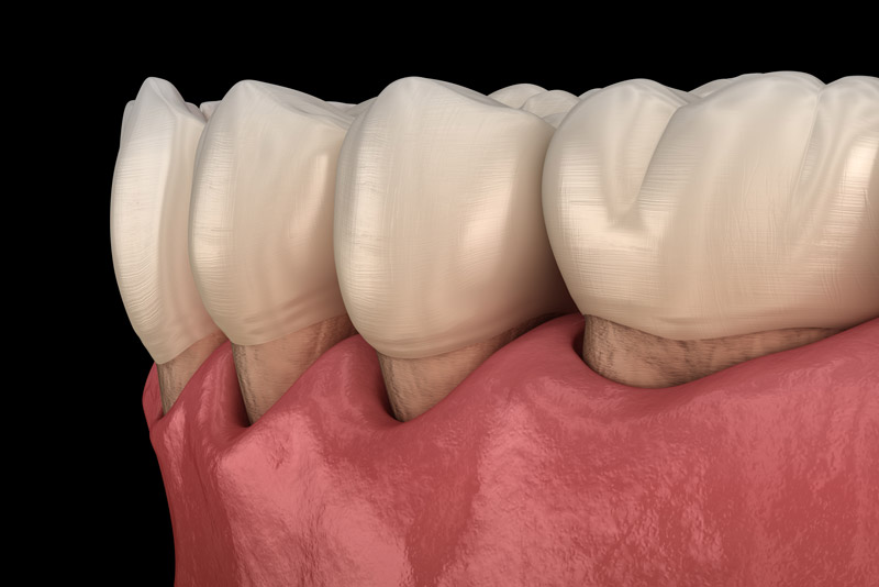 an image of gum recession model for a dental patient.