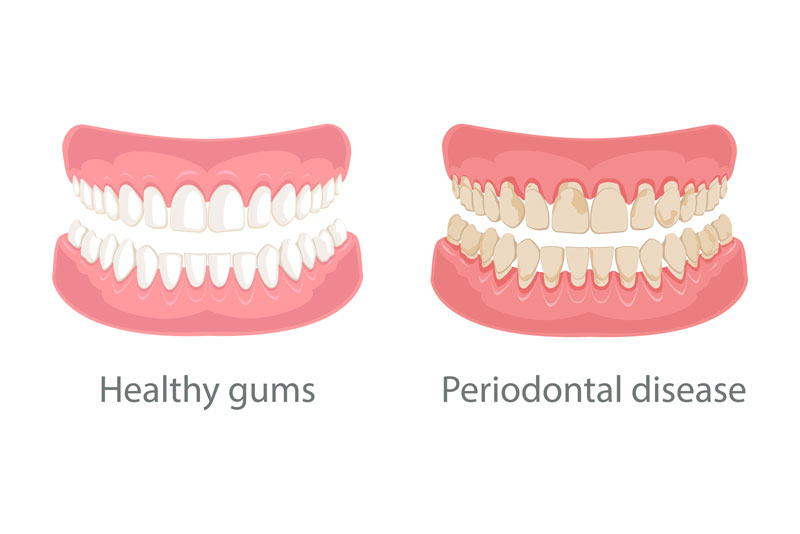 photo of a comparison between healthy gums and non healthy gums