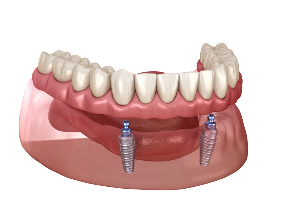 Mandibular removable prosthesis All on 2 system supported by implants with ball attachments. Medically accurate dental 3D illustration.