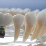 Image of a prosthesis jaw with a implant