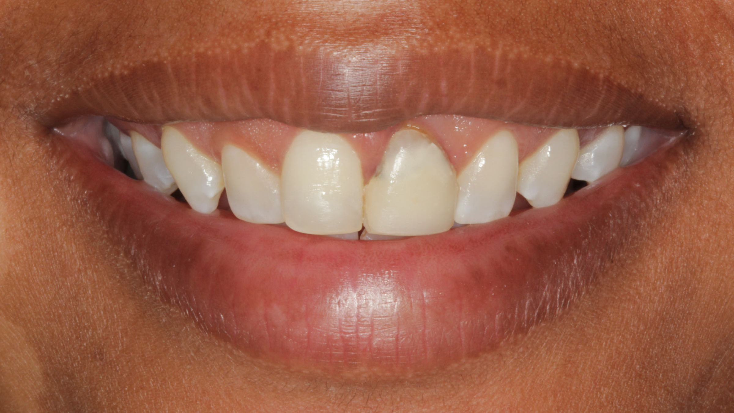 Straighten Your Teeth Invisibly with Invisalign in Baton Rouge