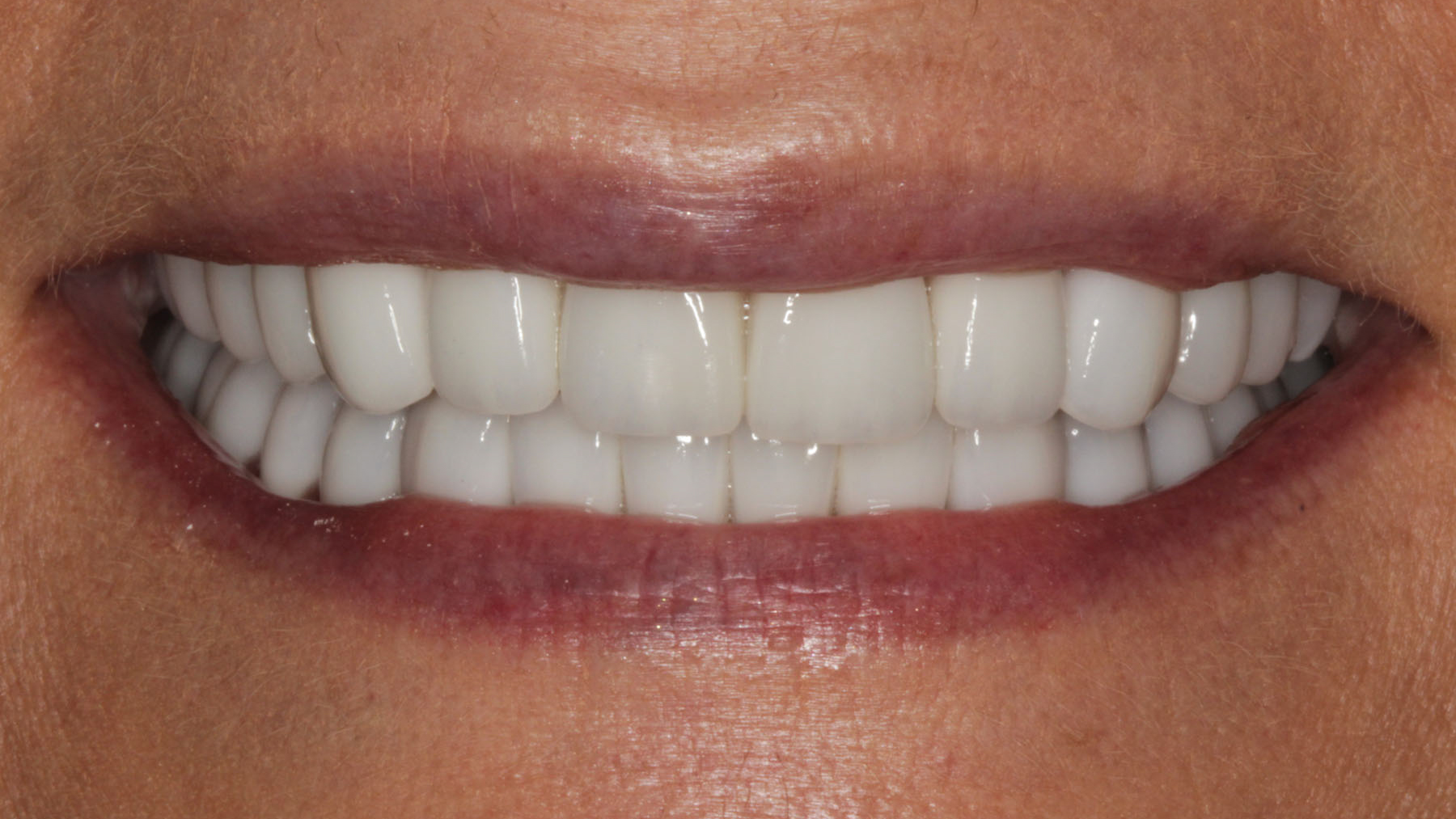 Brighten Your Smile with Professional Teeth Whitening in Baton Rouge