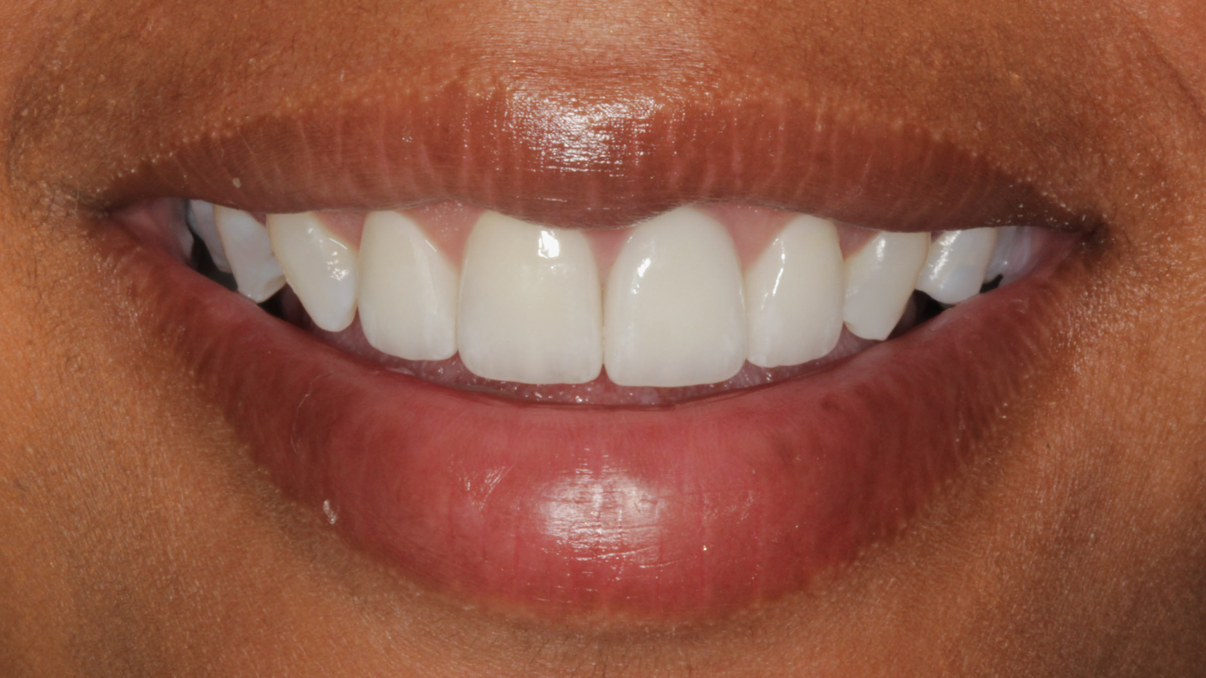 Stress-Free Dental Care: Sedation Dentistry in Baton Rouge