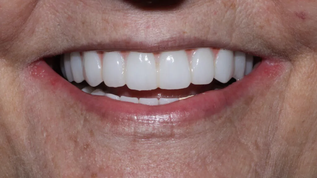 same day dental implants baton rouge teeth in a day dr andre bruni