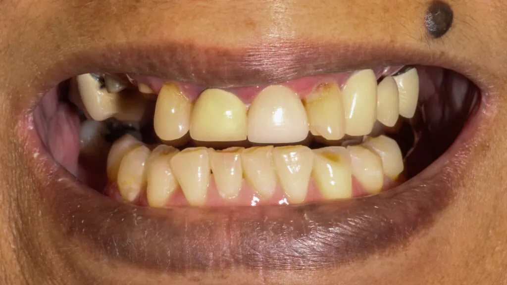 same day dental implants baton rouge full arch implants dr andre bruni