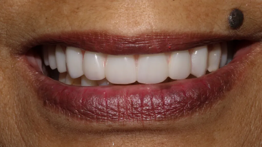 same day dental implants baton rouge full arch implants dr andre bruni