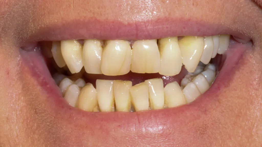 all on x dental implants baton rouge full arch dr andre bruni