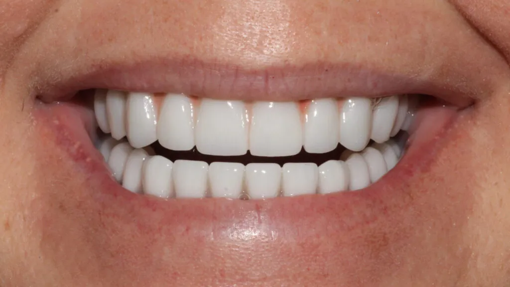 all on x dental implants baton rouge full arch dr andre bruni