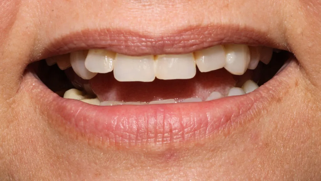 bite reconstruction baton rouge zirconia crowns full mouth dr andre bruni
