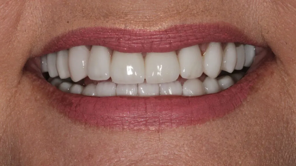 bite reconstruction baton rouge zirconia crowns full mouth dr andre bruni