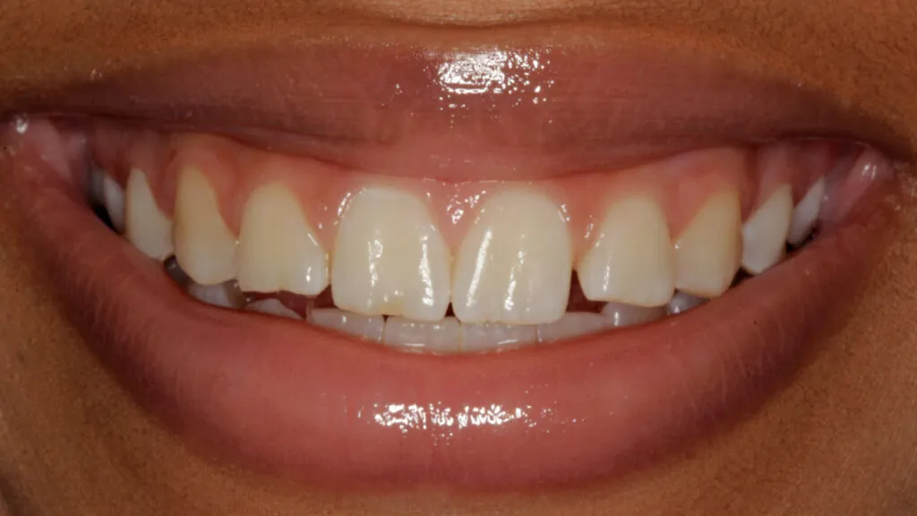 porcelain veneers baton rouge before after dr andre bruni pearl dental group