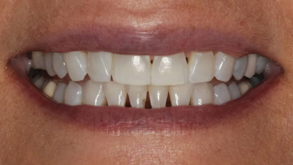smile makeover results baton rouge before after dr andre bruni