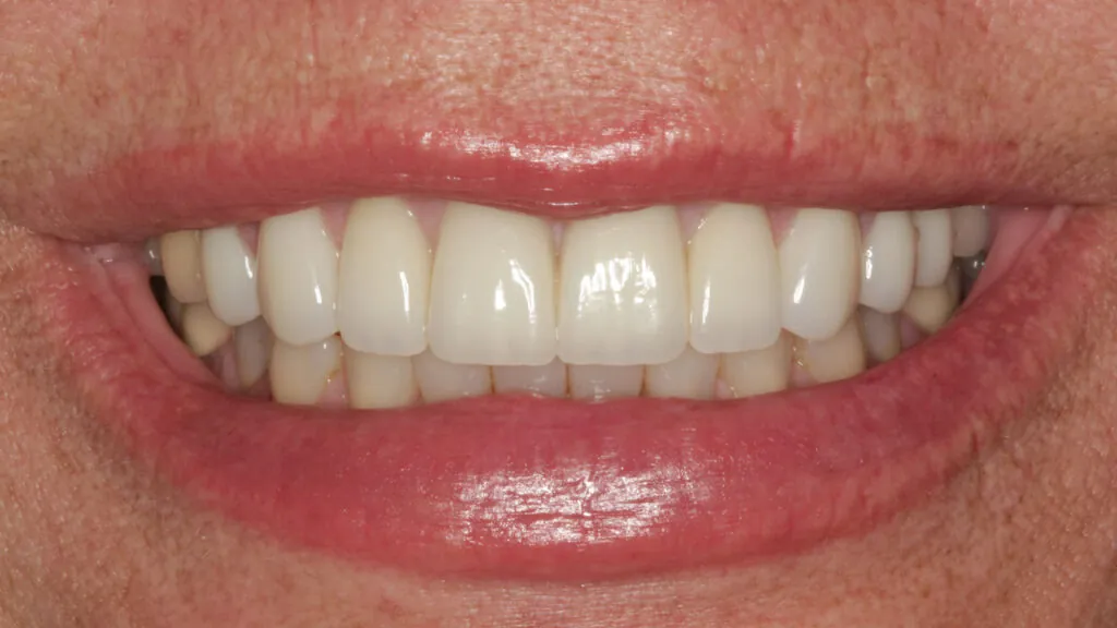 straight white smile makeover baton rouge dr andre bruni