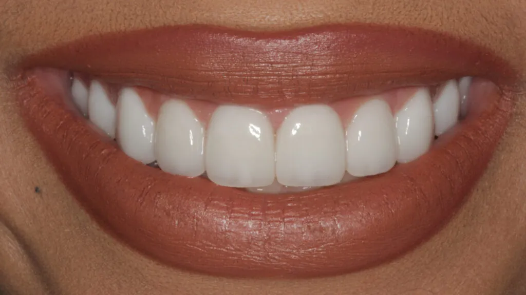 porcelain veneers baton rouge before after dr andre bruni pearl dental group