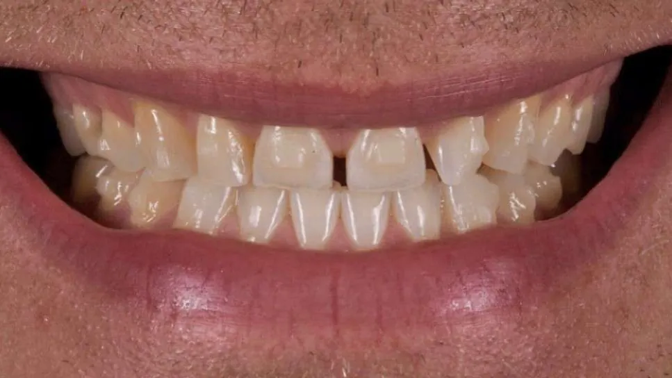 full smile transformation baton rouge cosmetic dentistry dr andre bruni
