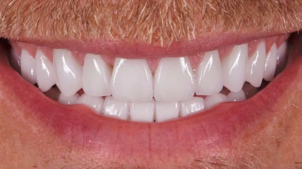 full smile transformation baton rouge cosmetic dentistry dr andre bruni