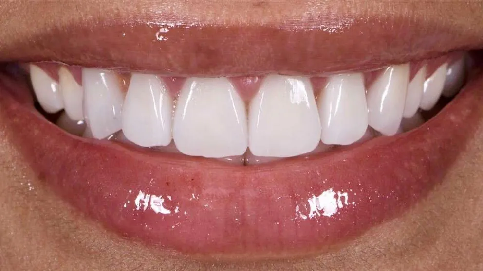 Close-up of a beautiful smile makeover with natural-looking porcelain veneers at Pearl Dental Group