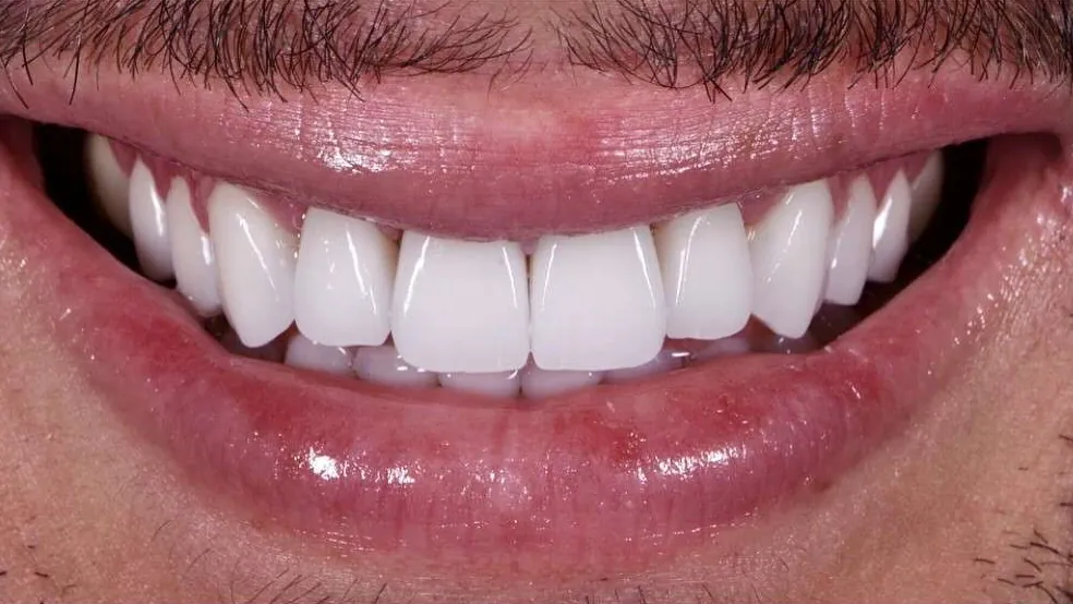 smile makeover baton rouge before after dr andre bruni pearl dental group