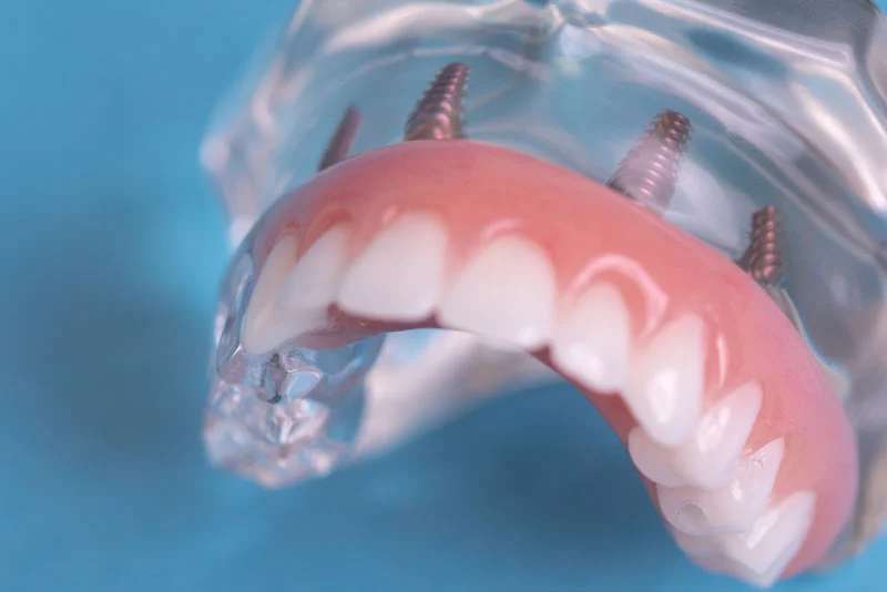 Implant-supported denture model showing how dental implants secure a full-arch replacement for missing teeth.