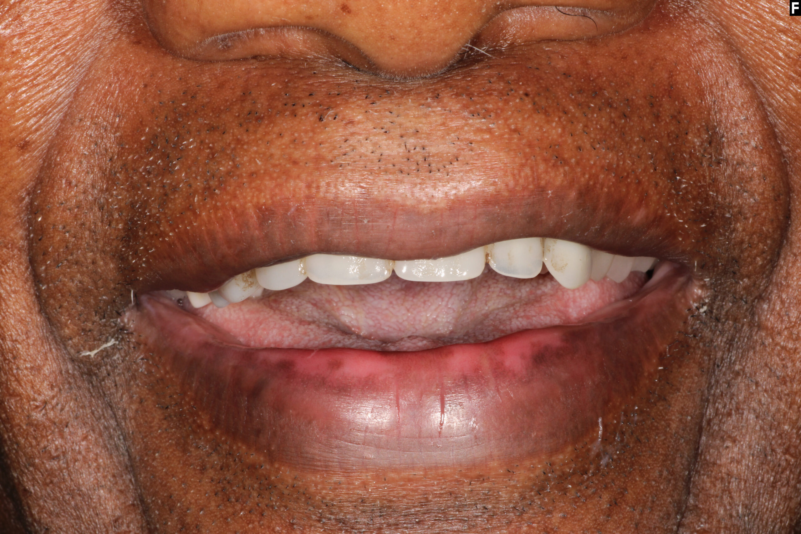 same day dental implants baton rouge teeth in a day dr andre bruni