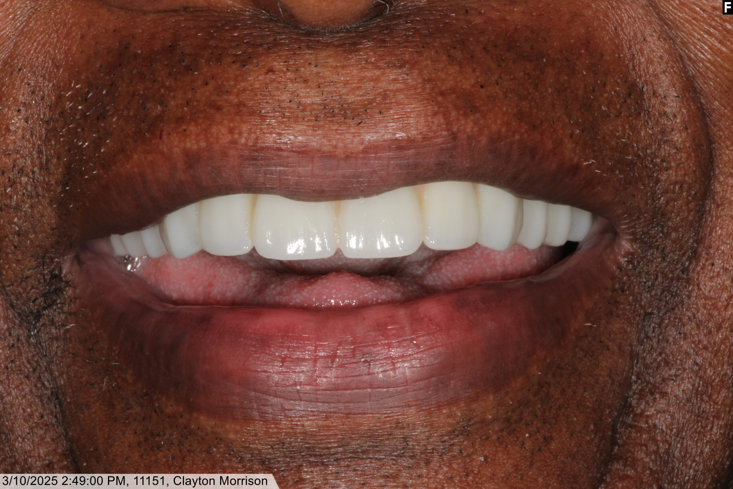 same day dental implants baton rouge teeth in a day dr andre bruni