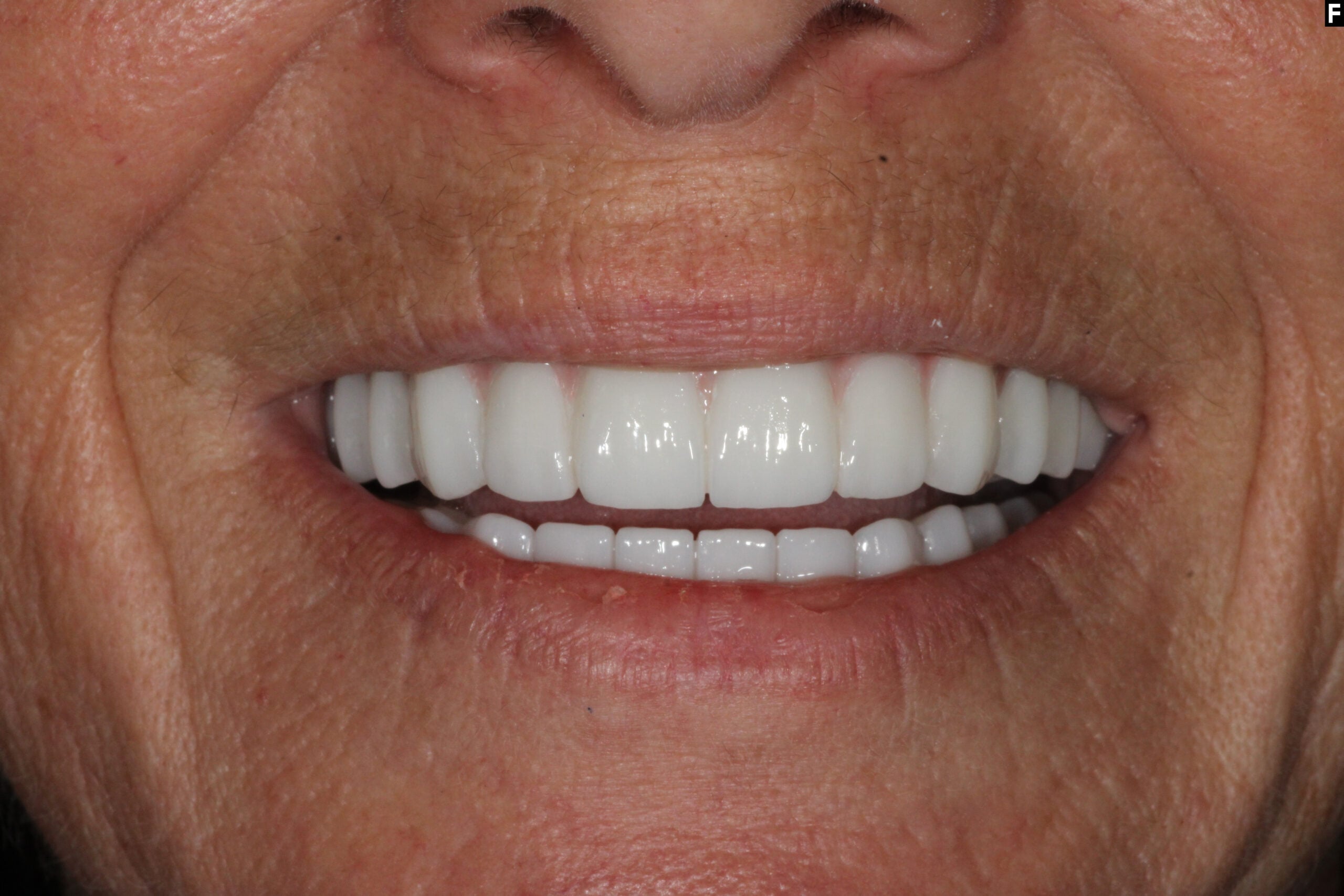 all on 4 dental implants baton rouge same day smile dr andre bruni