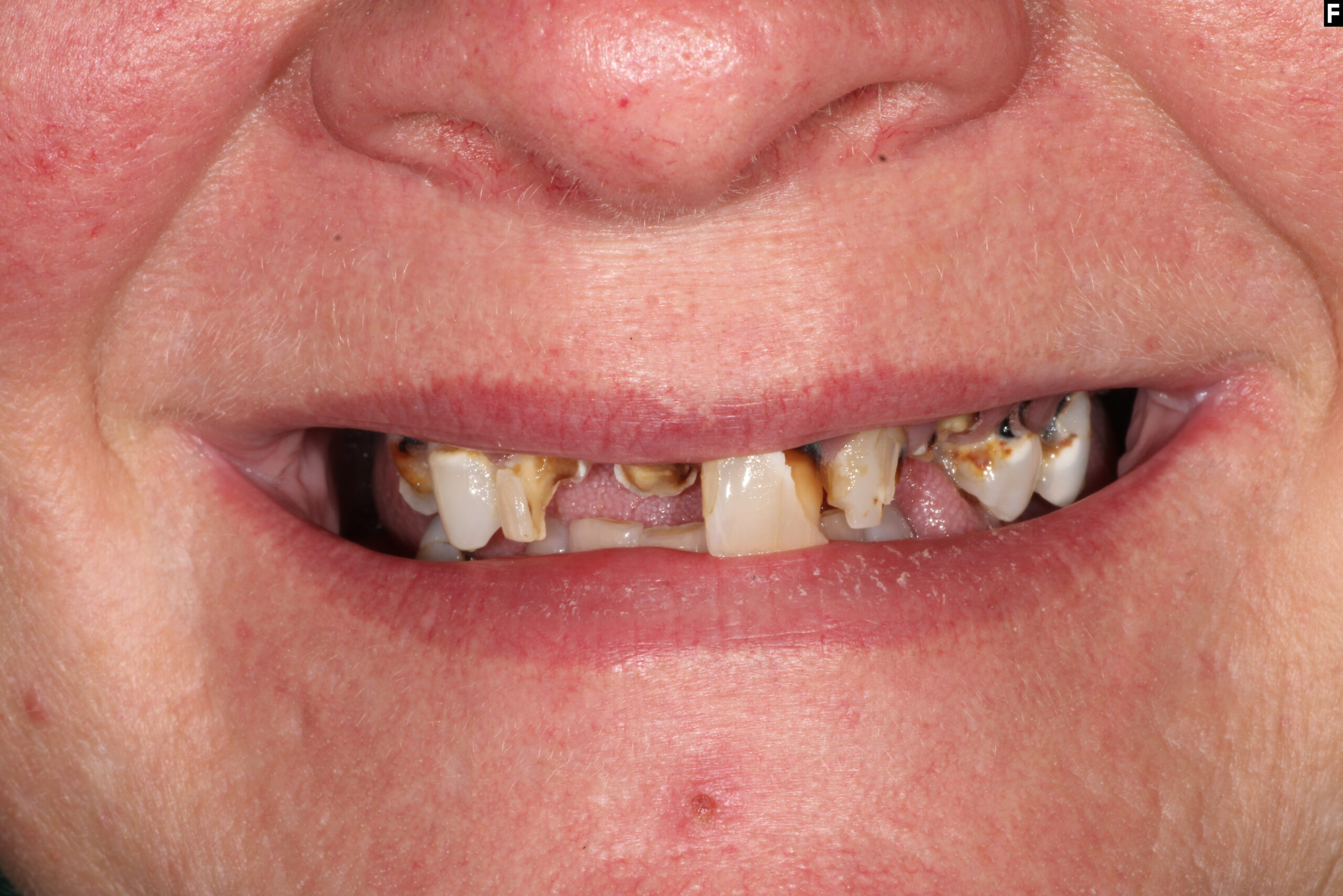 zirconia dental implants baton rouge full arch before after dr andre bruni