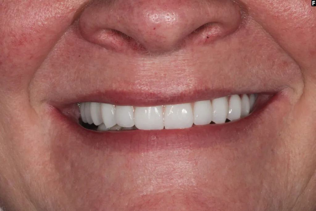 zirconia dental implants baton rouge full arch before after dr andre bruni