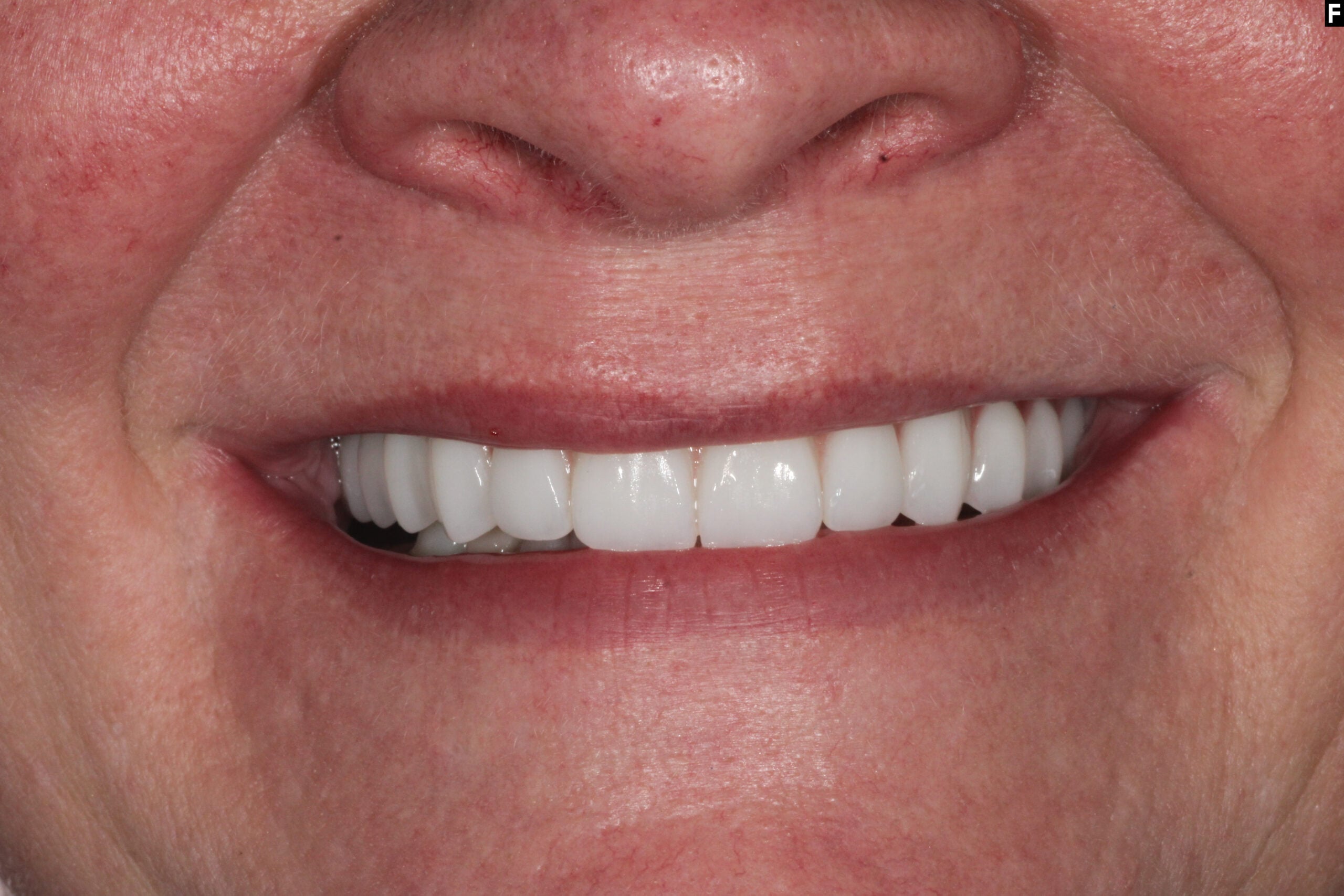 zirconia dental implants baton rouge full arch before after dr andre bruni