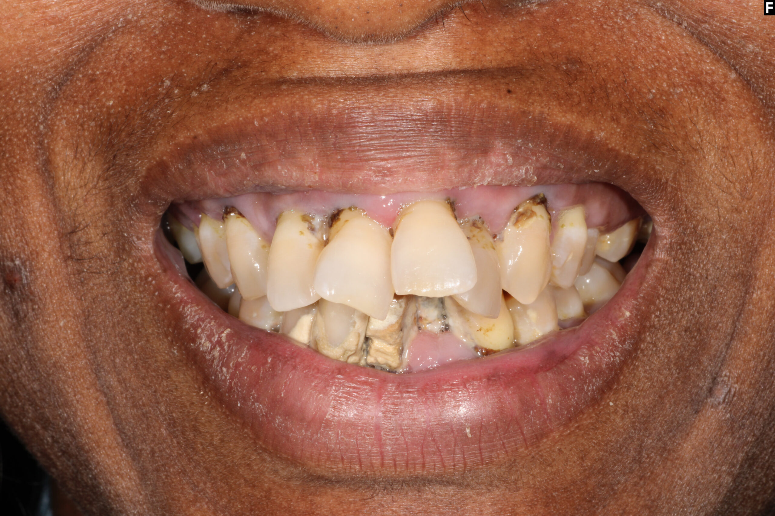dental implants baton rouge full mouth transformation dr andre bruni