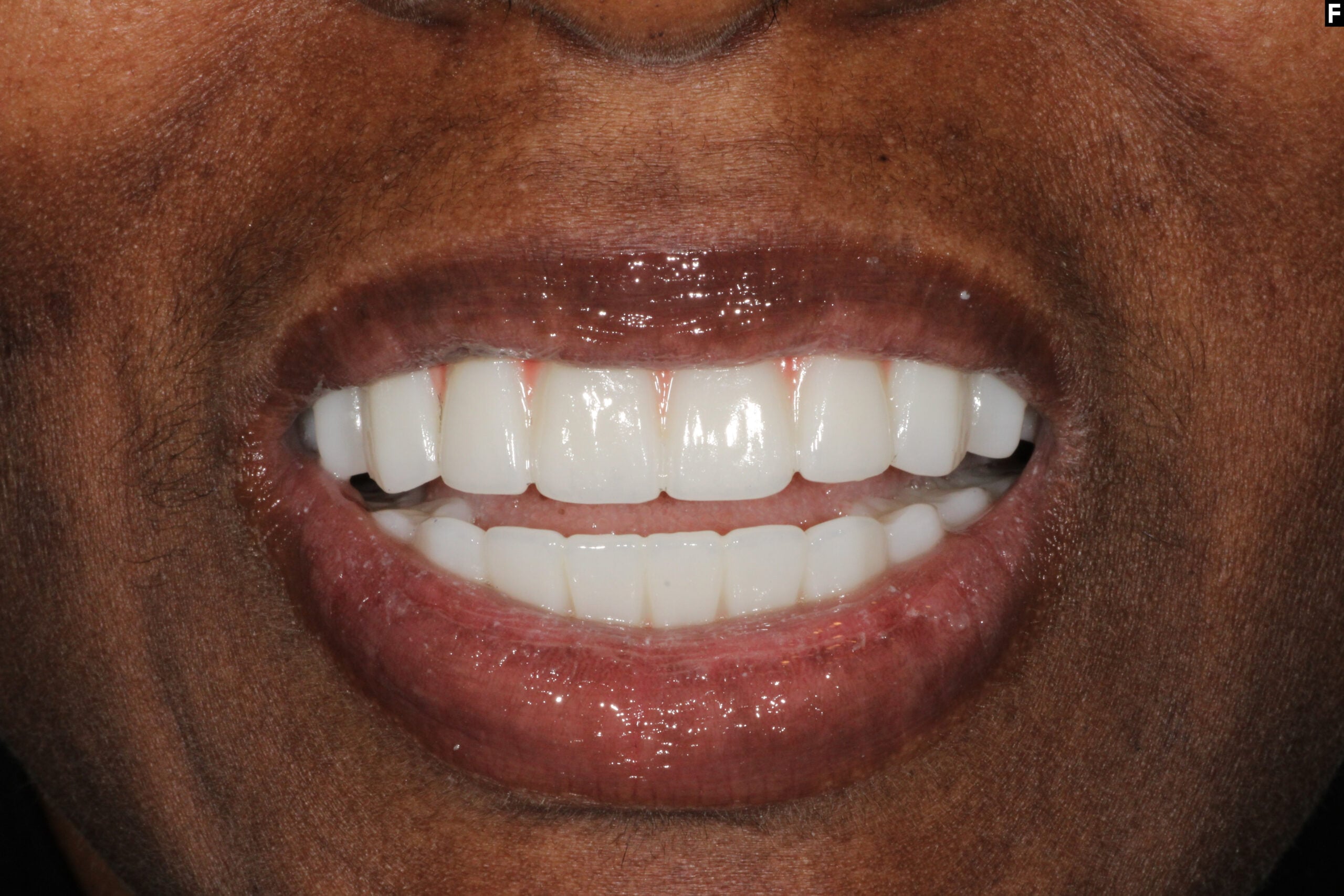 dental implants baton rouge full mouth transformation dr andre bruni